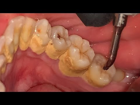 SCALING KARANG GIGI | Dentist | Dokter Gigi Tri Putra