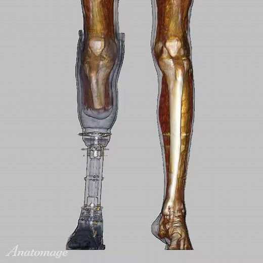 Amputated Lower Limb