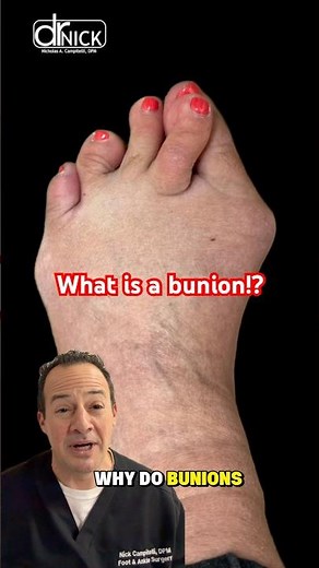 What is a bunion?!