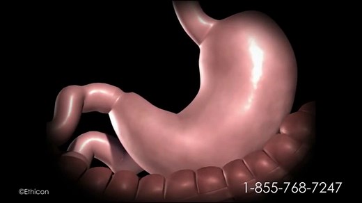 Duodenal Switch Surgery in Mexico