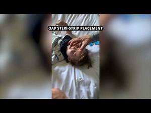 Infant with Pierre Robin Sequence (PRS) Treated with an Orthodontic Airway Plate (OAP)