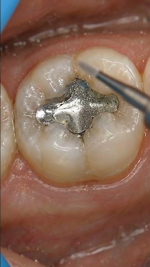 Replacing an Old Filling: Satisfying Transformation | #dentaltreatment #dentistry