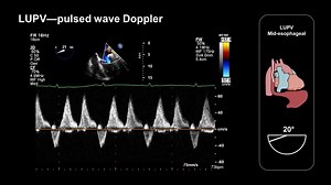 In this short video, you’ll learn how to find the left-sided pulmonary veins using TEE and how to assess flow using colour and PW Doppler. Find out more: http://bit.ly/2YCIt3l | Medmastery