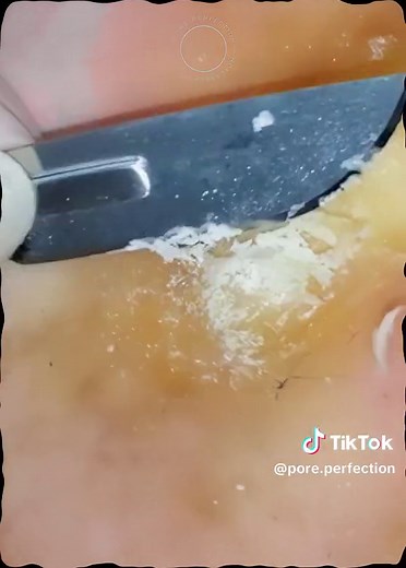 Try to Remove #satisfaction #cleaning #pimple #satisfying #foot