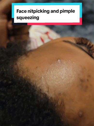 Face nitpicking and pimple squeezing...#asmr #fyp #relaxing #viral #goviral