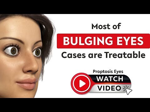 Understanding Proptosis: Causes, Symptoms, and Treatment Options