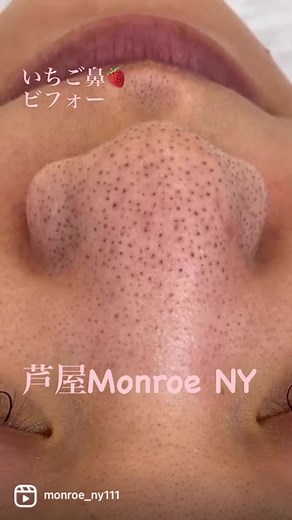 #毛穴 #エクストラクション #毛穴エクストラクション #毛穴エクストラクションモンロー式 #ポアニスト #美容 #クレンジング #角栓 #毛孔 #extractions