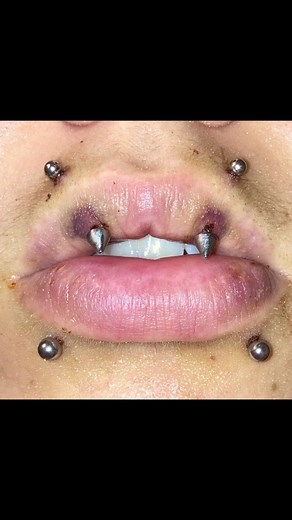 update! 2 months on T, 9 weeks on angel fangz and snake bites. changed the jewelry a couple of times for comfort with healing. Also been using minoxidil 1-3 times a day for about 2 months. #trans #lgbtq #ftm #TwoMonthsOnT #transMasc #nonbinary #queer #testosterone #transition #fyp #forYouPage