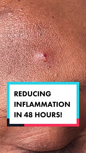 Dark skin suffers PIH (Post Inflammatory Hyperpigmentation) from spots/acne more than those with lighter skin due to melanin production and the inflammatory response. My partner in particular can have PIH last up to 3 months and be very dark in comparison to the surrounding skin. By using a hydrocolloid patch contains actives to target blemishes it was slightly noticeable after just 2 days. This is a huge improvement in the usual post acne mark. 🥇 #hydrocolloidbandages #hydrocolloidpatch #pimpl