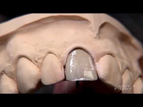 Characterize your dental restoration with GC OPTIGLAZE COLOR