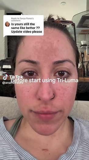 Replying to @Tonya Flores Sharing my journey as I go! #triluma #trilumacream #trilumareview #trimelasin #hydroquinonecream #hydroquinonetretinoin #hydroquinone #beforeandafter #skin #skincareroutine #skincaretips