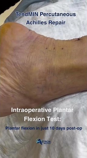 Percutaneous Achilles Repair With TendMIN™ : Intraoperative and Post Op Results