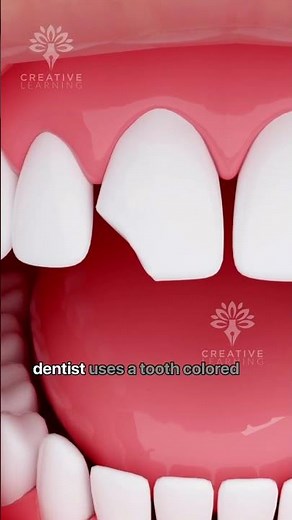 How Does Bonding Fix a Chipped Tooth #shorts #tooth - Creativelearning3d