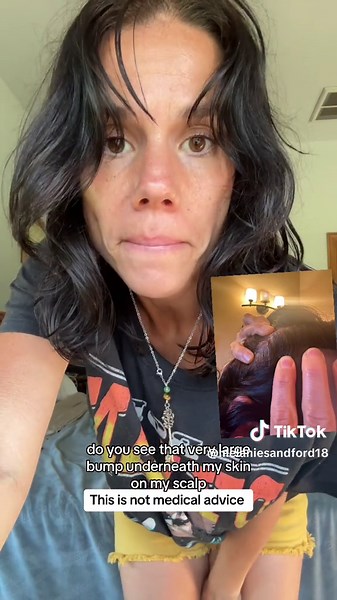 Castor oil shrank my pilar cyst down to half in one night—in one freaking night! My stepdaughter couldn’t even believe it she was like what?! because she saw me put it on the night before I showed her this morning she was in shock y’all Stay tuned #castoroil #pilarcyst #holistichealing #fyp #greenscreensticker