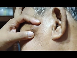 Giant Pimple Popping Part 2