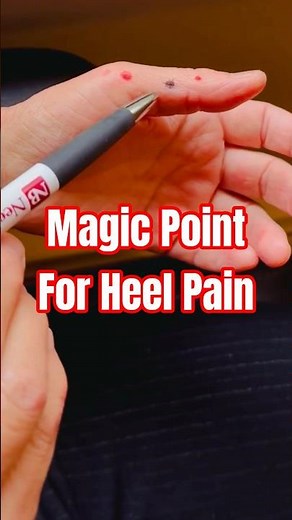 Heel pain relief using Master Tung’s Wu Hu Sen points! #acupuncture #heelpain #mastertung