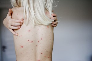 Symptoms, complications, diagnosis and treatment of tertiary syphilis