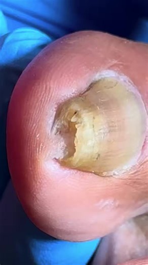 13K views · 122 reactions | Doctors Couldn’t Believe What Was Inside This Toenail A738 #ASMR #SatisfyingVideo #FootCare #PedicureASMR #IngrownToenail #MedicalASMR #fblifestyle Beautiful moments of care and relaxation through a gentle pedicure experience. Simple, clean, and satisfying. ✨ Disclaimer: This video is for educational and relaxation purposes only. All content belongs to the respective owners, no copyright infringement is intended. | FC Studio | Facebook