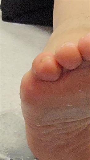 Hey Foot Fam, here’s how years of wearing the wrong shoes can impact your feet 👣 This patient wore high heels and narrow shoes for years, and now has a bunion with toes beginning to shift and overlap. If not managed, this can continue to worsen, especially with tight footwear. That’s why our chiropodists recommend a full assessment and a footwear audit to address any underlying biomechanical issues. The sooner you get your feet checked, the easier it is to prevent painful problems later on. #fo