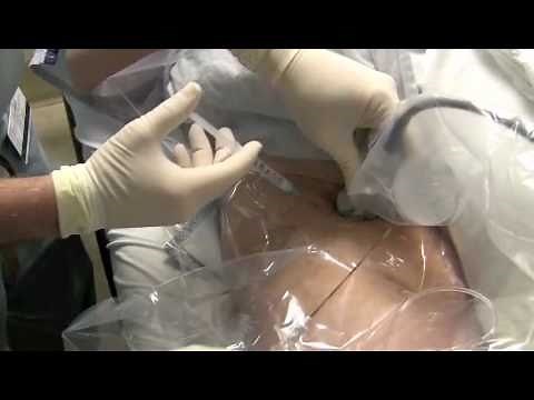 Ultrasound-guided Continuous Femoral Nerve Block