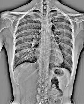 Chest X-Ray in Motion
