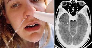 After Seattle Woman Has Seizure And Dies, Doctors Say She Made Fatal Mistake With Neti Pot