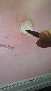 Porokeratosis right foot, "seed wart."