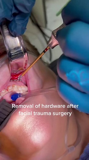 Temporary Hardware removal