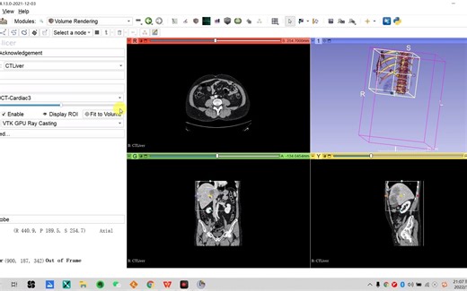 3d slicer进行肝脏肿瘤分割，计算剩余肝体积及提取影像组学特征