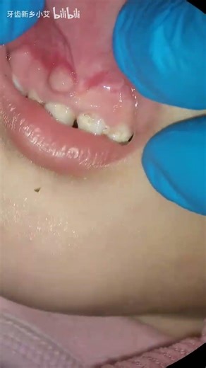 Two-year-old toothache caused by decayed front teeth and root bump