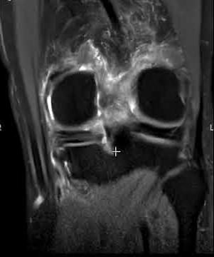 Typical radiology pattern - Medial meniscus root tear