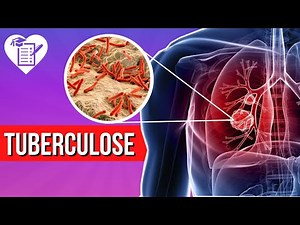 TUBERCULOSE: O que é, Sintomas e Tem Cura?