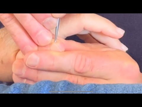 Hand Reflexology Massage Using Acupressure Pen Part 4 of Brandon Massaging Kim’s Hand in Australia.