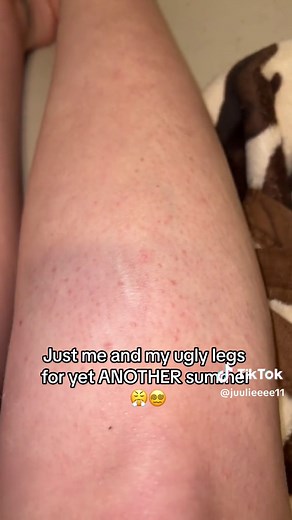 How to Get Rid of Small Red Bumps on Legs | Leg Skincare Tips