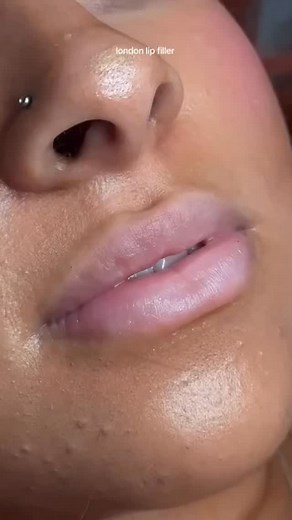 Dermal fillers plump up wrinkles, smooth lines and restore volume in your face. Your healthcare provider injects these substances just under your skin. People choose to get dermal fillers to enhance their facial features or gain a more youthful appearance | Dreamy Day Aesthetics | Facebook