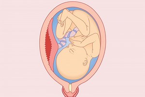 Placenta Separation in Early Pregnancy | LoveToKnow Health & Wellness