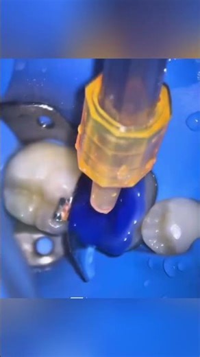 Avoid a Root Canal! How Pulp Capping Saves Your Tooth #shorts #dentist #dentistry #smilemakeover