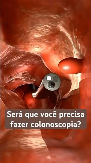 Quem precisa fazer colonoscopia?