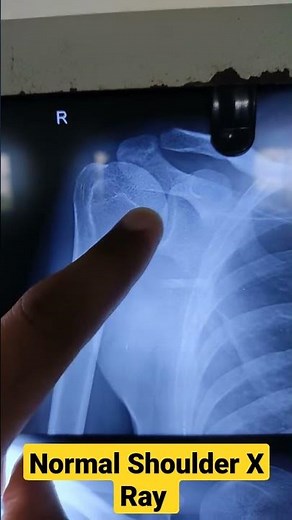 Normal Shoulder X Ray...Dr Sai Chandra MBBS DNB Ortho