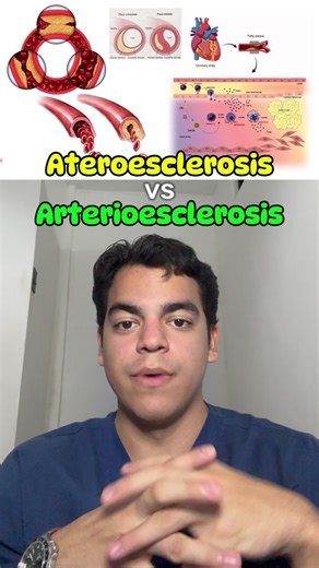 Tipos de Arteriosclerosis: Diferencias y Síntomas