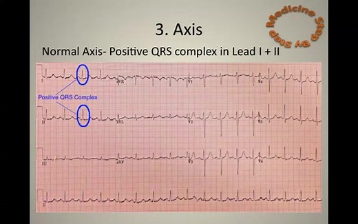 5.1K views · 304 reactions | 11 steps to read an ECG Note: There is a correction in the video. P-R interval extends from the beginning of the P wave (the onset of atrial depolarization) until the beginning of the QRS complex (the onset of ventricular depolarization). | Davidson's Principles and Practice of Medicine | Facebook