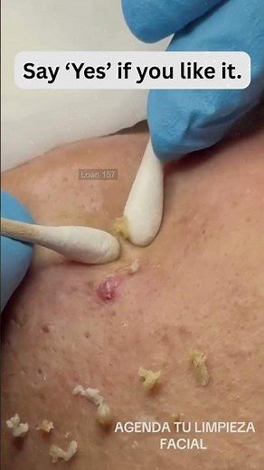🔥Deep Blackheads, Milia & Whitehead Removal pimple popping New| Big Cystic Acne Extraction#1280 2026