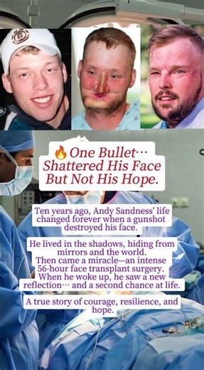 Andy Sandness Face Transplant: 56-Hour Surgery That Changed His Life Forever