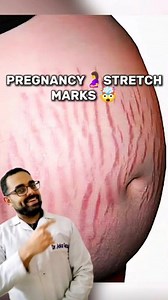 Pregnancy Stretch Marks 🤯 #pregnancystretchmarks #stretchmarksremoval | Dr Ankur Gautam