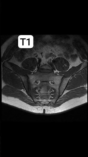 sacroiliitis with subchondral bone marrow edema and marginal erosions#radiology #anatomy #mriscan
