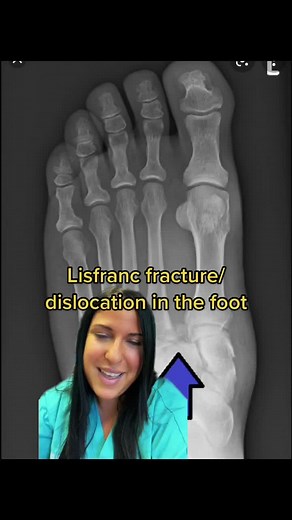 #foot#footpain #trauma #surgery #nosurgery#injection #dislocation #podiatry #medicine #sports #athlete #cast #fracture #stemcells #arthritis #treatmen