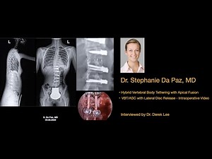 Dr. Stephanie Da Paz, MD - Lateral Disc Release and Hybrid VBT with Apical Fusion Scoliosis Surgery