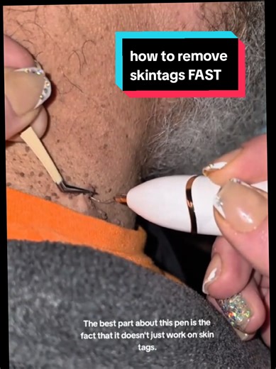 How to Effectively Remove Skin Tags with a Pen