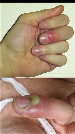 Digital Pressure Test for Paronychia – Quick Clinical Exam #meded #emergencymedicine #physio #atc