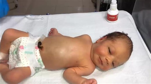 Baby Undergoes U.C Tube Insertion & Blood Exchange Transfusion | NICU Care & Initial Assessment #babycare #viral #cutebaby #hungry #baby #newbornbaby | Anoop Gautam